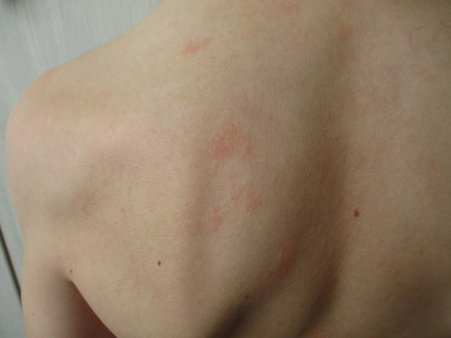 rash, allergic reaction, hives