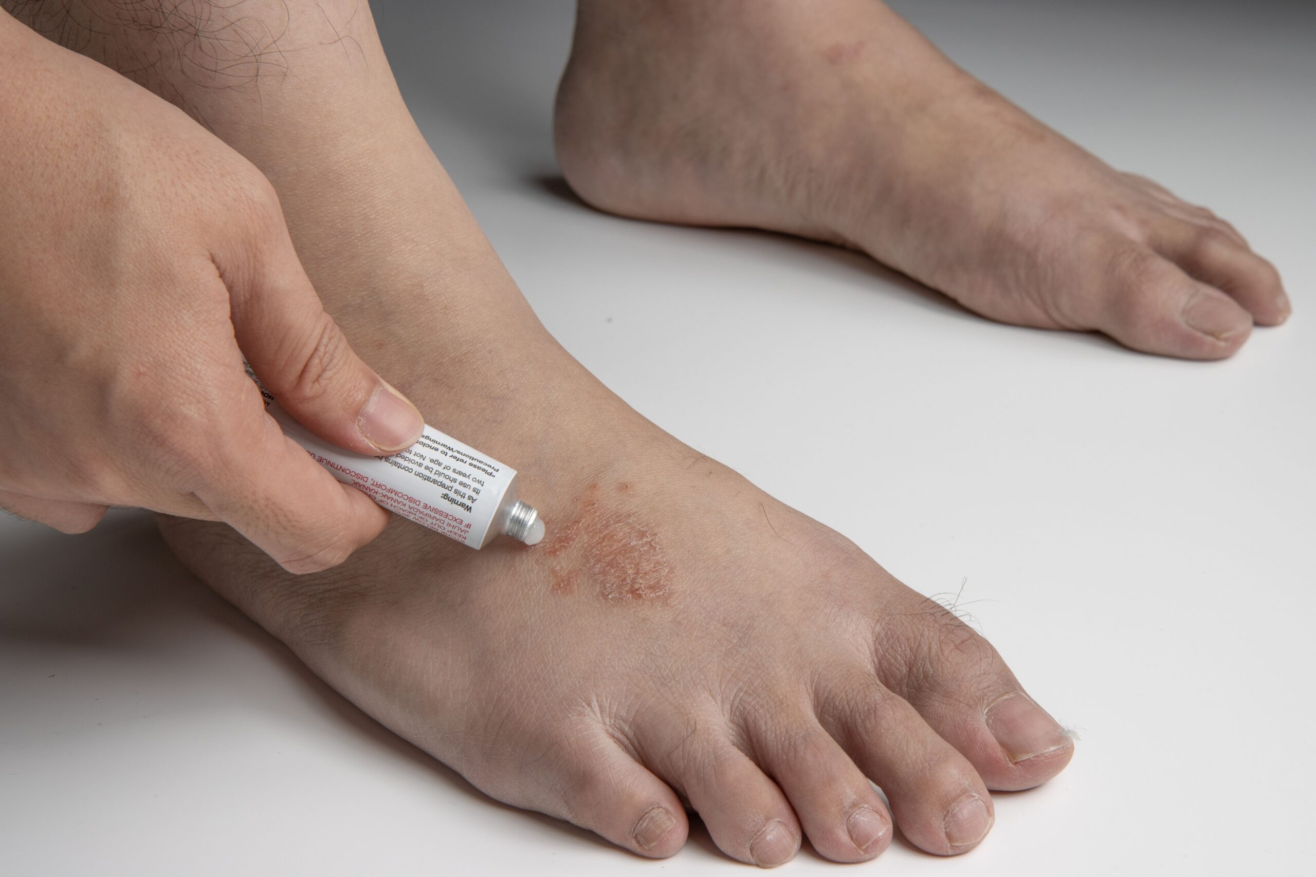 Antifungal Cream Used on Foot