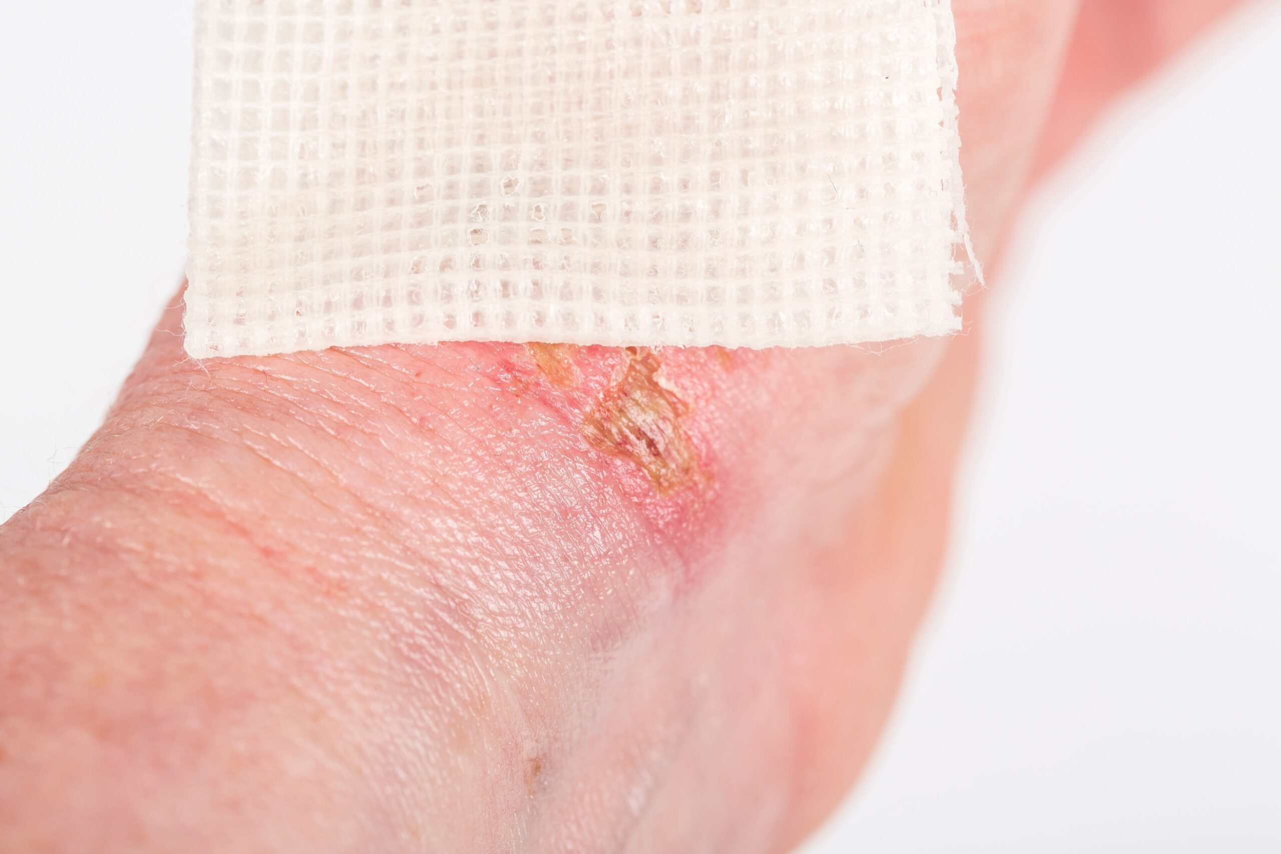 Burn dressing on burn wound