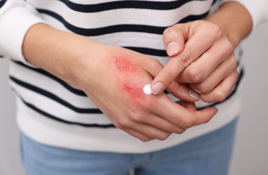 Woman applying burn cream to burn on her hand